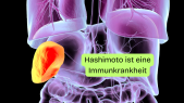 thumbnail of medium H4: Hashimoto ist eine Immunkrankheit
